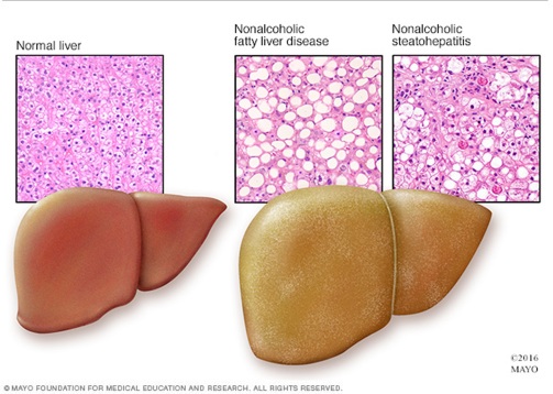 fatty-liver-and-non-alcoholic-fatty-liver-disease
